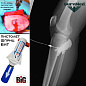 Шприц пистолет для внутрикостного доступа Биг Bone Injection Gun B.I.G. Big pediatric red (детский 18g)